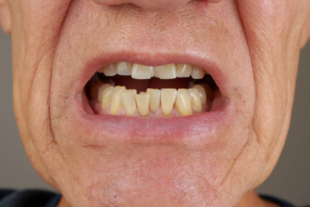 istock Man showing his two front Incisors teeth that are chipped 2167463339