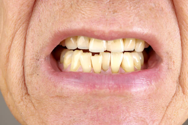 Stacked or overlapping teeth with yellow stain of Asian man. Also called crowded teeth.