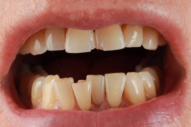 istock Man showing his two front Incisors teeth that are chipped 2167463366
