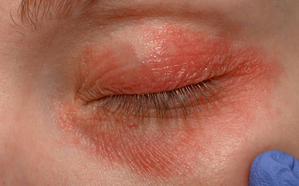 istock Blepharitis, eyelid eczema close up 2167510748