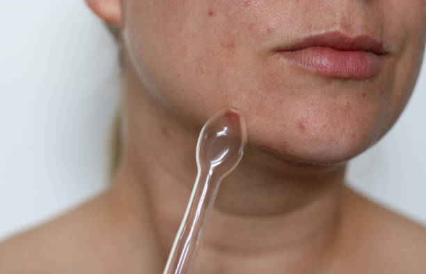 istock Close up of woman using a high frequency darsonval device on acne skin, blurry white background 2167589590