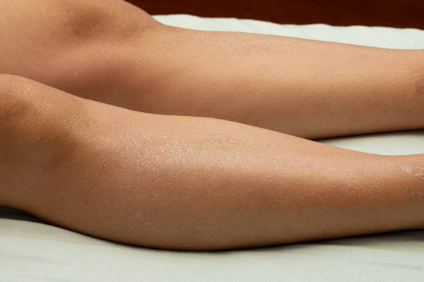 istock Woman's legs with dry skin that is ashamed. 2167725336
