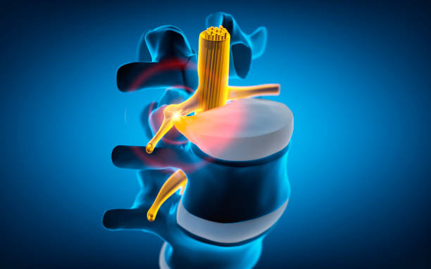 istock Spinal cord under pressure of intervertebral disc 2167937999