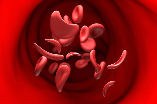 Sickle cell anaemia - section view 3d illustration stock photo