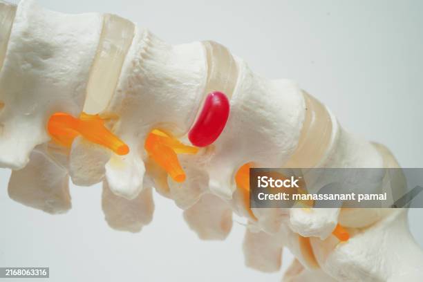 Rare Spinal Disc Spinal Nerve And Bone Lumbar Spine Displaced Herniated Disc Fragment ...
