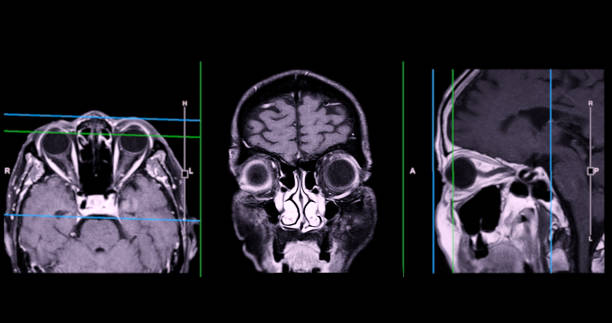 istock Image of MRI orbit scan with gadolinium contrast in normal case displays comprehensive views for eye disease diagnosis. 2168489854
