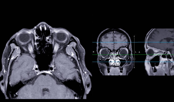 istock Image of MRI orbit scan with gadolinium contrast in normal case displays comprehensive views for eye disease diagnosis. 2168489946