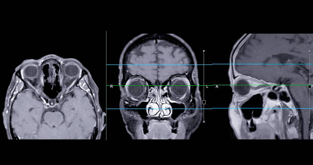 istock Image of MRI orbit scan with gadolinium contrast in normal case displays comprehensive views for eye disease diagnosis. 2168489951