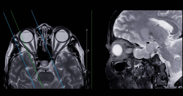 istock Image of MRI orbit scan with gadolinium contrast in normal case displays comprehensive views for eye disease diagnosis. 2168489974