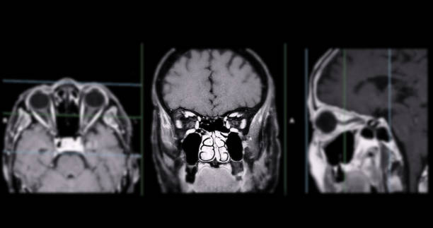 istock Image of MRI orbit scan with gadolinium contrast in normal case displays comprehensive views for eye disease diagnosis. 2168489983