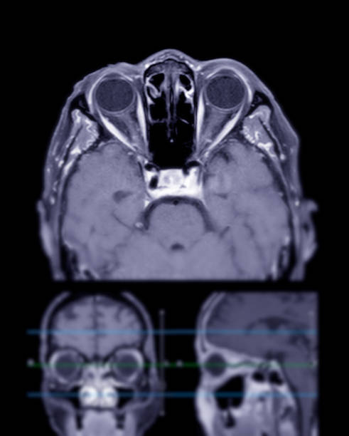 Image of MRI orbit scan with gadolinium contrast in normal case displays comprehensive views for eye disease diagnosis.