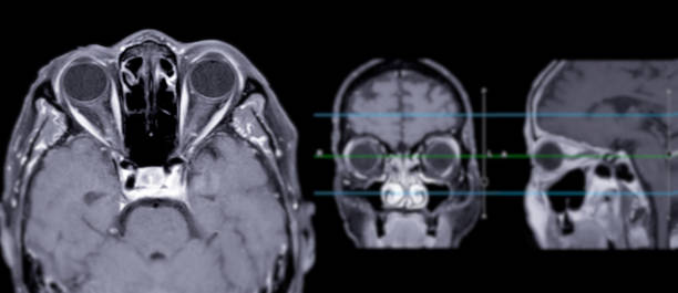 istock Image of MRI orbit scan with gadolinium contrast in normal case displays comprehensive views for eye disease diagnosis. 2168490019
