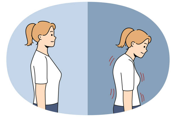 Stooped woman before and after correcting posture thanks to massage therapist or chiropractor Stooped woman before and after correcting posture thanks to massage therapist or chiropractor helping to get rid of scoliosis. Girl with bad posture due to lordosis and kyphosis or spinal defect kyphosis stock illustrations