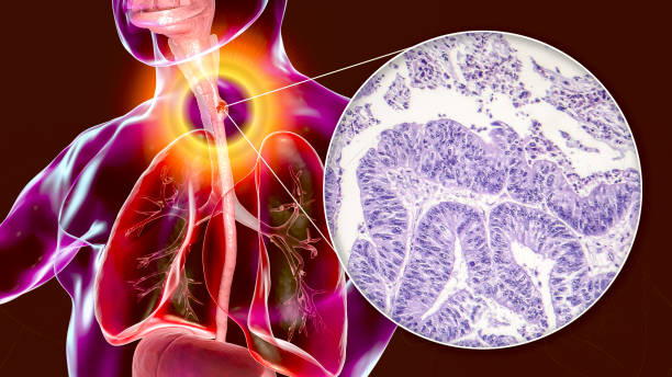 Oesophageal cancer, composite illustration