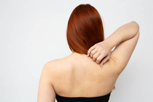 istock Young woman scratching itchy back skin problem 2169065004