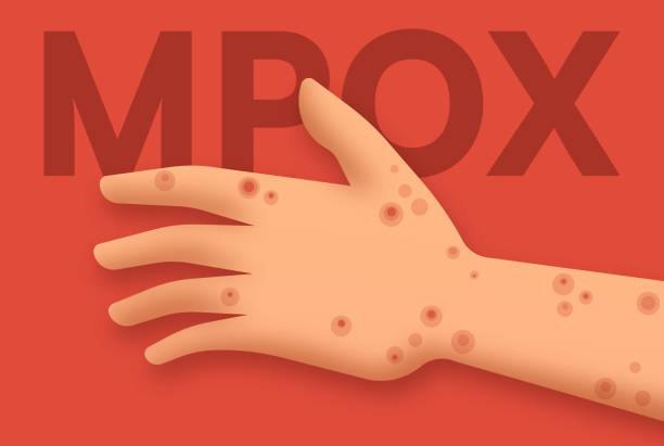Smallpox Rash Cartoon 130+ Smallpox Rash Stock Illustrations, Royalty-Free Vector Graphics ...
