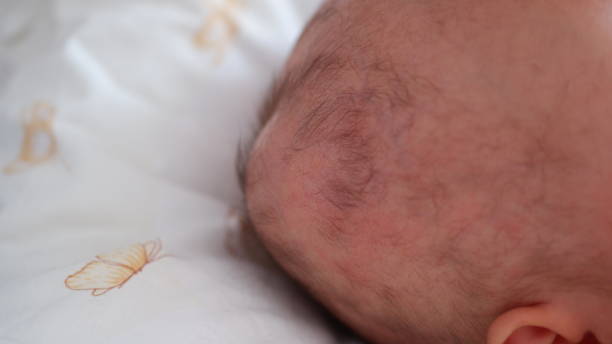 istock Lump on the newborn's baby scalp. 2169682026