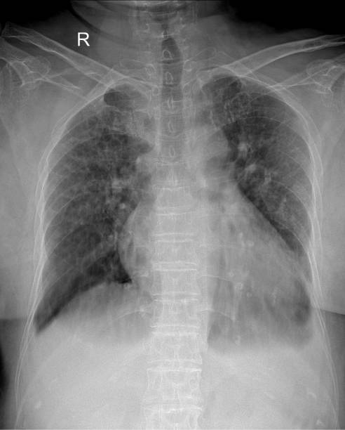 Chest X-Ray: Imaging of the Thorax Chest X-Ray: Diagnostic Imaging of the Thorax pulmonary nodules stock pictures, royalty-free photos & images