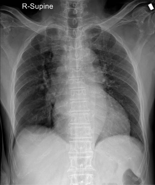 Chest Radiograph Chest Radiograph: Diagnostic Tool for Thoracic Pathology pulmonary nodules stock pictures, royalty-free photos & images