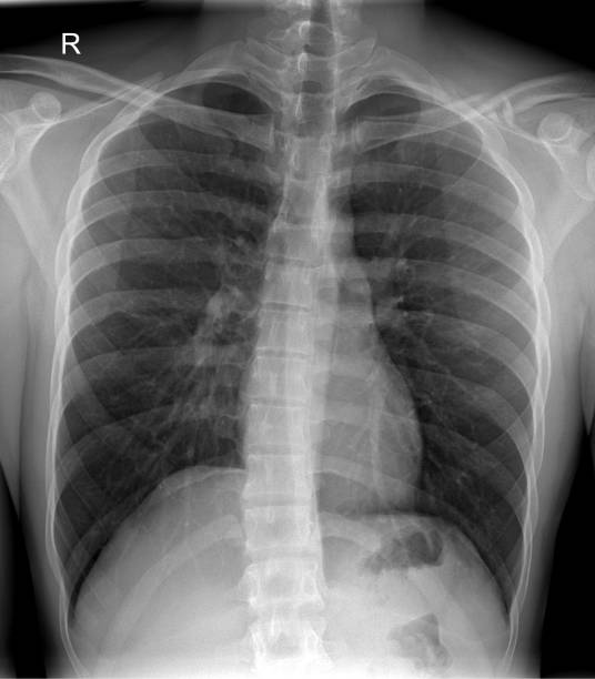 Chest Radiograph Chest Radiograph: Diagnostic Tool for Thoracic Pathology pulmonary nodules stock pictures, royalty-free photos & images