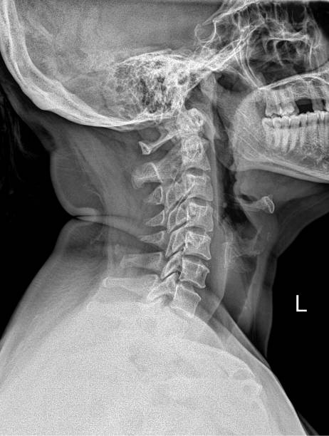 X-ray of neck and cervical spine side view.