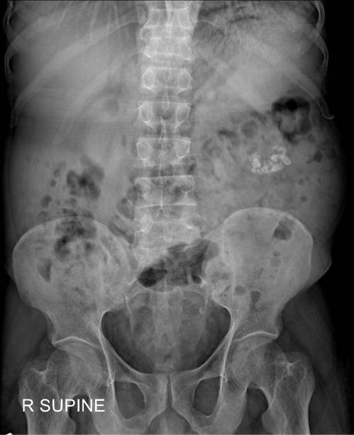 istock Kidneys, Ureters, and Bladder X-ray  Stones 2169817335