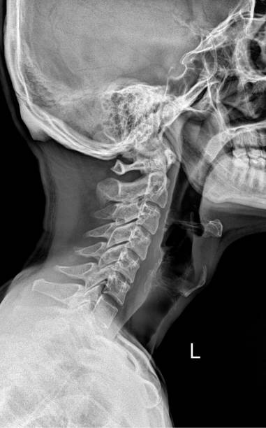 istock X-ray of neck and cervical spine side view. 2169818496