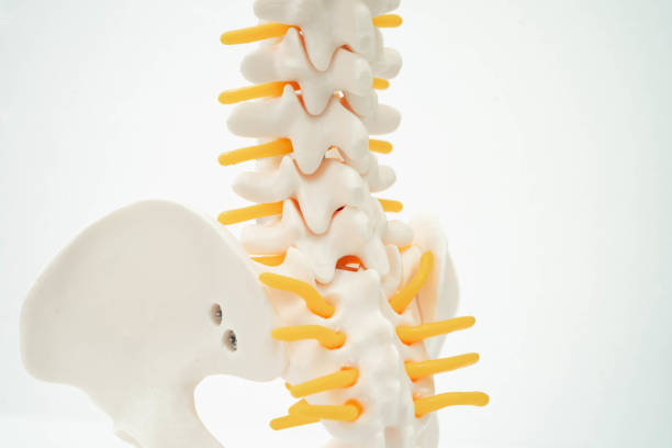 istock Lumbar spine displaced herniated disc fragment, spinal nerve and bone. Model for treatment medical in the orthopedic department. 2169840634