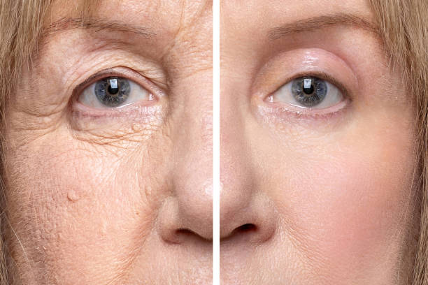 istock Lower and upper eyelid blepharoplasty 2169977799
