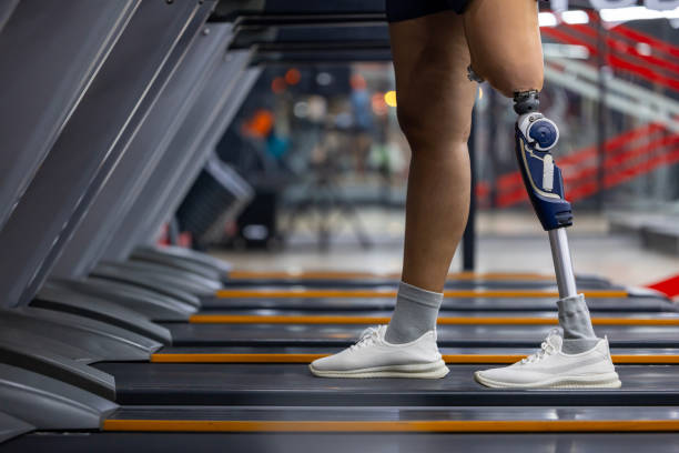istock People with prosthetic leg doing walking workout exercise using treadmill at gym for healthy and recovery 2170282922