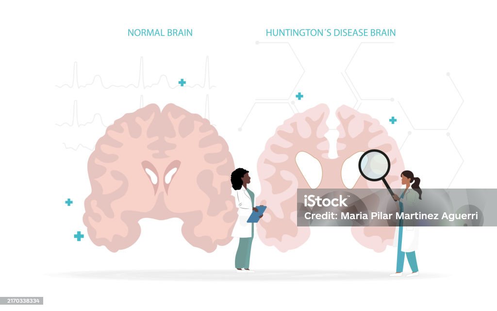 Not Normal Brain Comparison Between A Normal Brain And One Affected By Huntingtons ...