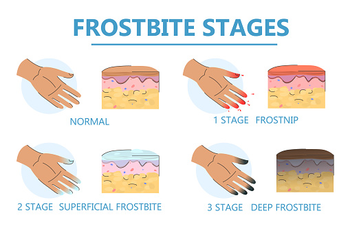 Frostbite Examples Frostbite Stages Infographic Vector Isolated Stock Illustration ...
