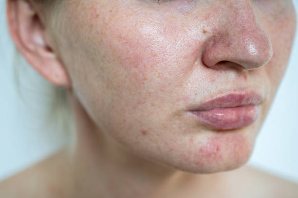 istock Rosacea and freckles on a woman's face close-up 2170398268