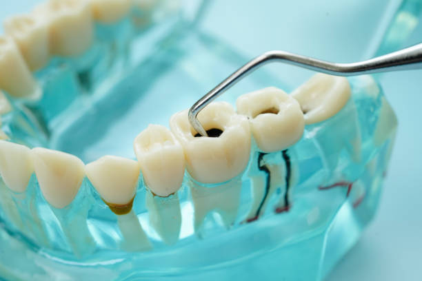 istock Teeth dental model with tool for dentist use to cleaning care treatment. 2170615832