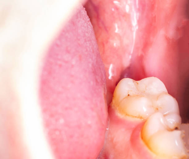 istock recess after complex impacted wisdom tooth extraction, traumatic healing. Dry socket, alveolitis, macro. Copy space for text 2170668196