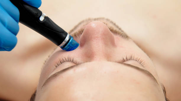 istock A man undergoes a hydrofacial treatment at a beauty clinic. This advanced procedure rejuvenates and revitalizes the skin, ideal for showcasing premium skincare services in your advertising. 2170814426