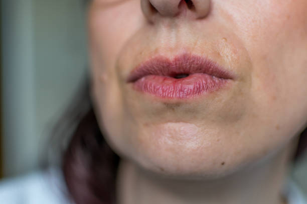 istock Old scar above lip on face 2170923384