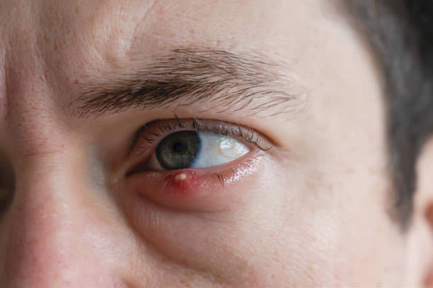 istock Man with infected chalazion (stye, barley) eye on lower eyelid 2170943539