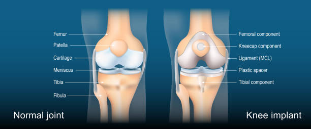 Total knee arthroplasty. Knee joint replacement Total knee arthroplasty. Knee joint replacement. Anatomy of Normal joint and Total Knee implant. Detailed vector poster. Isometric flat illustration. Schematic diagram femur bone anatomy drawing stock illustrations