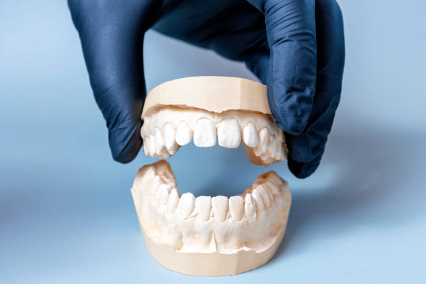 istock A gloved hand holds a dental plaster mold of teeth 2171001224