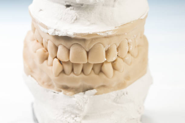 Malocclusion teeth. Plaster Dental model with jaws. Cast of teeth.