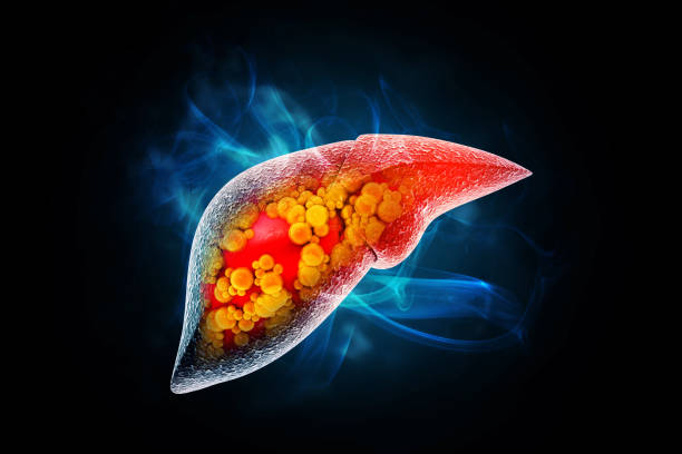 Liver damage such as Fatty liver, Fibrosis, Cirrhosis, and Liver cancer. 3d illustration Liver damage such as Fatty liver, Fibrosis, Cirrhosis, and Liver cancer. 3d illustration liver disease stock pictures, royalty-free photos & images