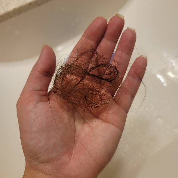 istock Hair Loss 2171192291