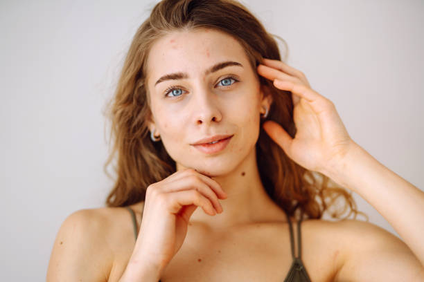 istock Beautiful young girl with problem skin. 2171219876