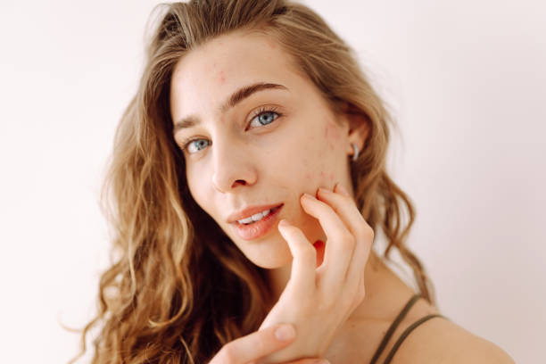 istock Beautiful young girl with problem skin. 2171219880
