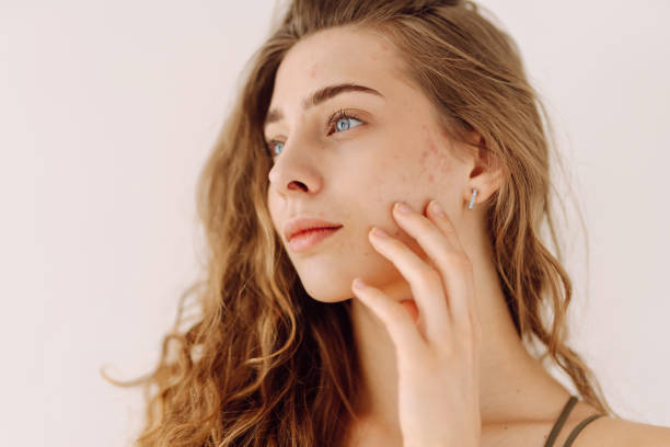 istock Beautiful young girl with problem skin. 2171219885