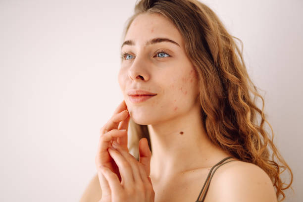 istock Beautiful young girl with problem skin. 2171219912