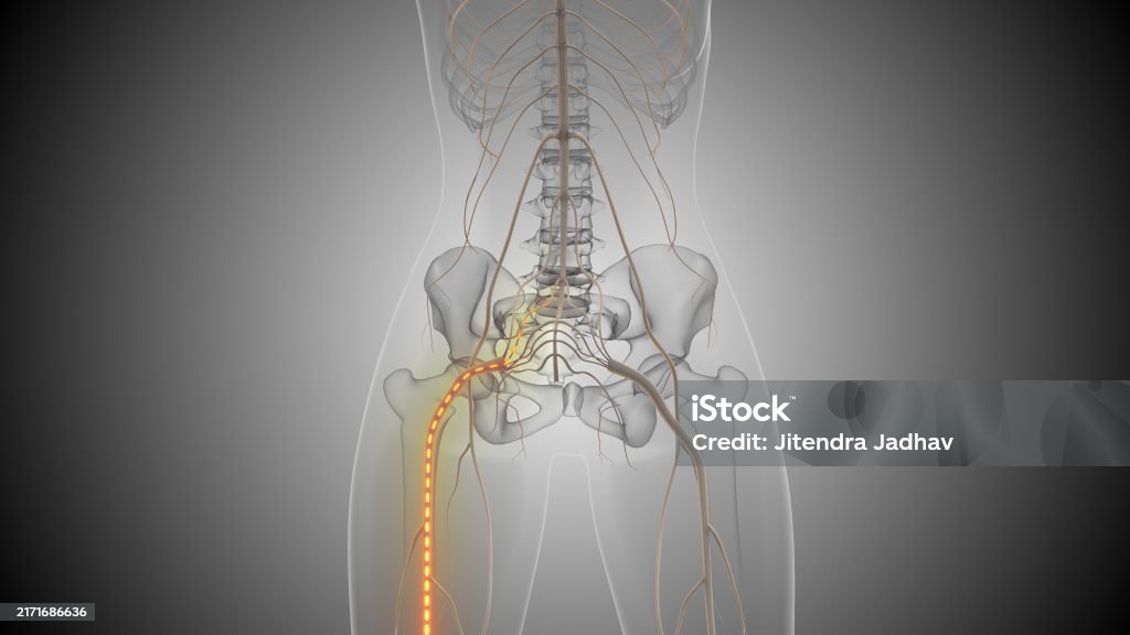 Sciatica Radiating Sciatica Causes Lower Back And Leg Pain Stock Photo - Download Image ...