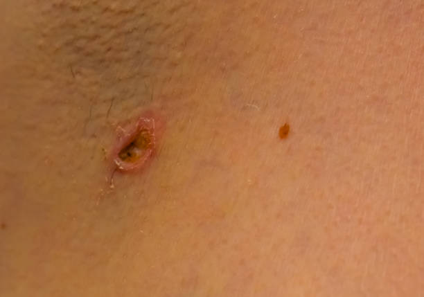 istock infected wound closeup, complication after birthmark removal surgery 2171726611