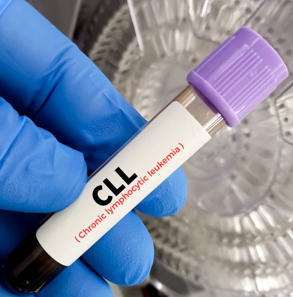 istock Chronic Lymphoblastic Leukemia (CLL) blood test. Blood cancer. 2171855051